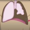 Chest Seal | Vented